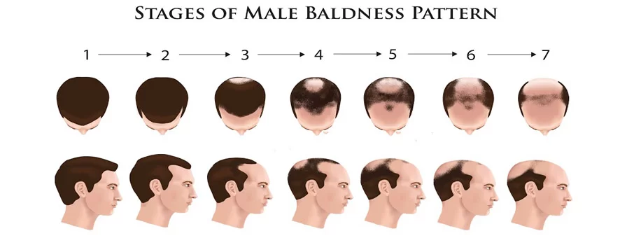 hair loss progress men 1.jpg